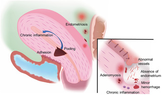 Prevalence, definition, and etiology of cesarean scar defect and treatment of cesarean scar disorder: A narrative review.