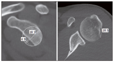 TREATMENT OF RECURRENT ANTERIOR SHOULDER DISLOCATION USING THE LATARJET TECHNIQUE.