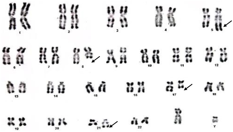 A novel t (5; 17) (q35; q21) associated with t (8; 21) (q22; q22) in a patient with acute myeloid leukemia: case report and review of literature.