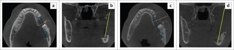 The radiologic progression of ameloblastomas.