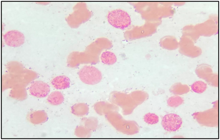 A novel t (5; 17) (q35; q21) associated with t (8; 21) (q22; q22) in a patient with acute myeloid leukemia: case report and review of literature.