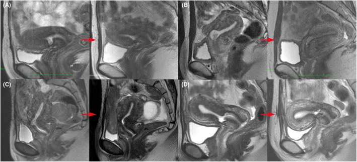 Prevalence, definition, and etiology of cesarean scar defect and treatment of cesarean scar disorder: A narrative review.