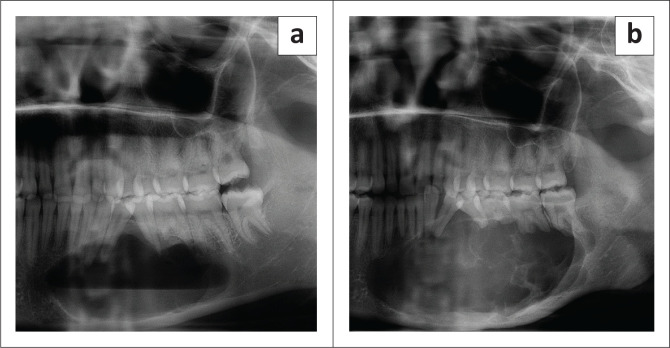 The radiologic progression of ameloblastomas.