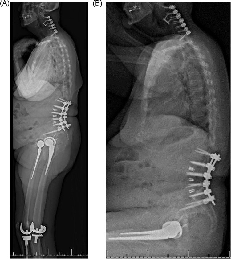 Projected Savings Associated with Lowering the Risk of Total Hip Arthroplasty Revision Due to Dislocation in Patients with Spinopelvic Pathology.