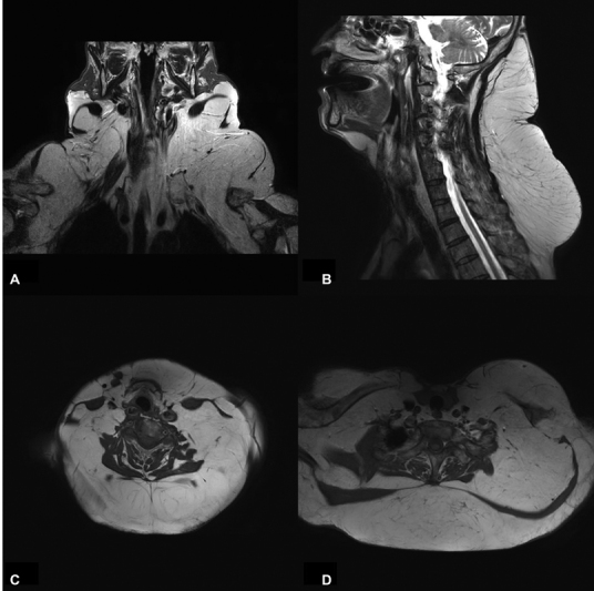 A Case Report of Madelung's Disease.