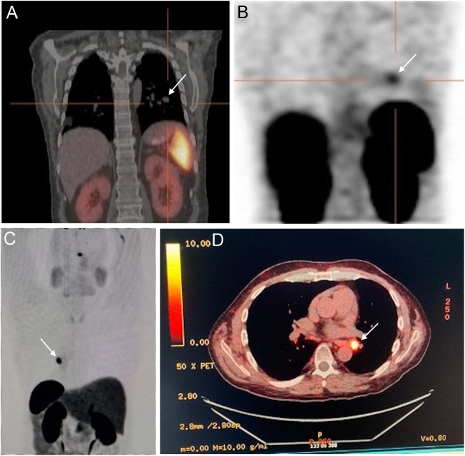 Ectopic ACTH Cushing's syndrome caused by a large-cell neuroendocrine lung carcinoma responding to desmopressin.