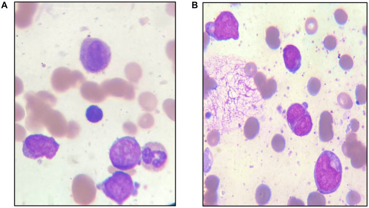 A novel t (5; 17) (q35; q21) associated with t (8; 21) (q22; q22) in a patient with acute myeloid leukemia: case report and review of literature.