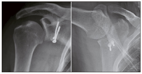 TREATMENT OF RECURRENT ANTERIOR SHOULDER DISLOCATION USING THE LATARJET TECHNIQUE.