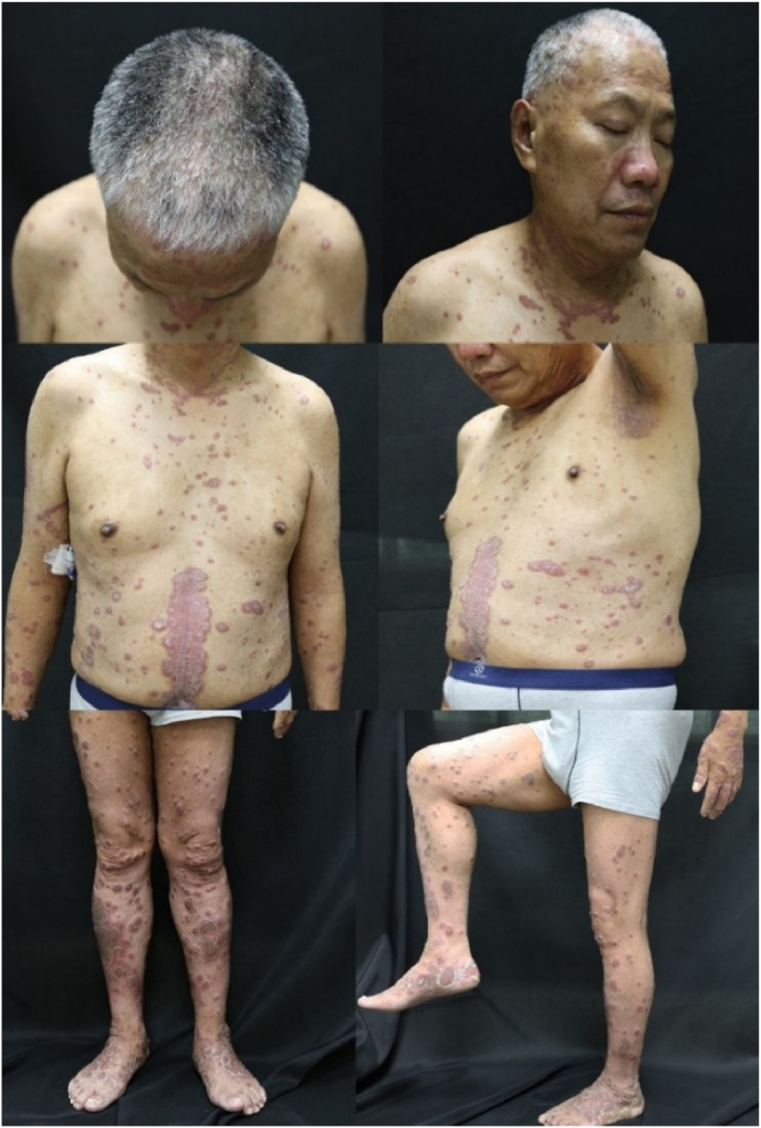 Exacerbation of psoriasis induced by Nivolumab in a patient with stage IIIc gastric adenocarcinoma: A case report and literature review