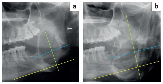 The radiologic progression of ameloblastomas.