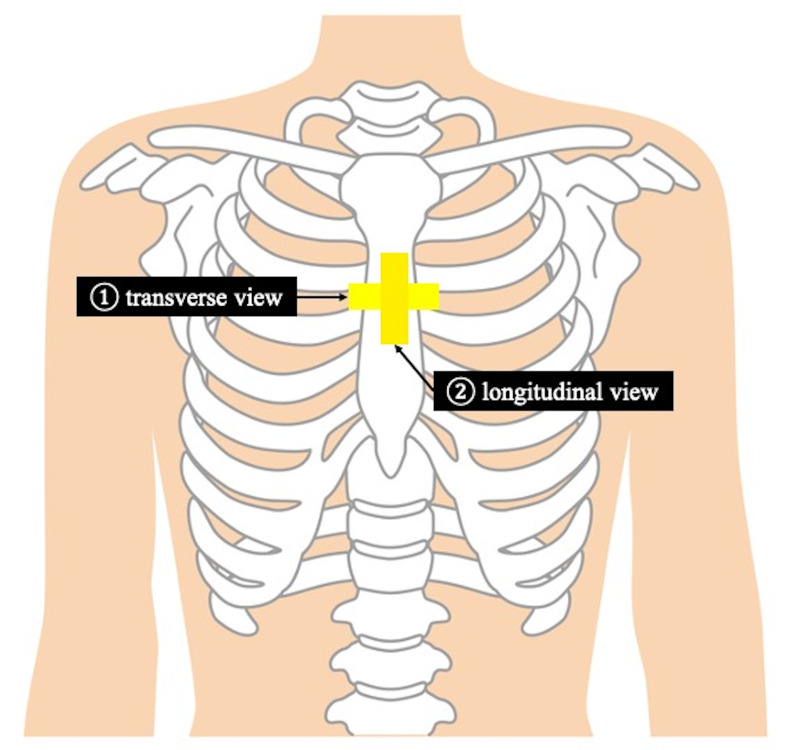 A Case of Pediatric Sternal Fracture Diagnosed by POCUS.