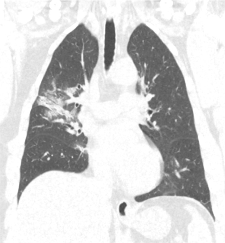 Cytokine Release Syndrome (CRS) in Severe COVID-19 Patients: Two Controversial and Interesting Case Reports and Literature Review.