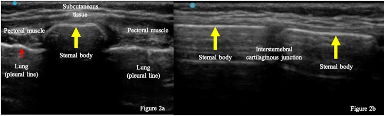 A Case of Pediatric Sternal Fracture Diagnosed by POCUS.