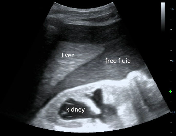 Delayed Iatrogenic Bladder Rupture Diagnosed by POCUS in the Emergency Department.