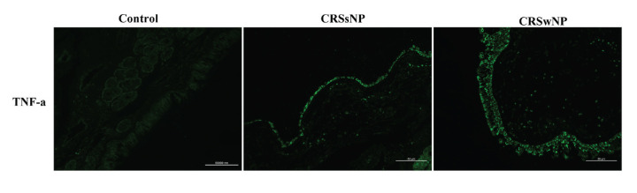 TNF-α Regulates the Glucocorticoid Receptor Alpha Expression in Human Nasal Epithelial Cells Via p65-NF-κb and p38-MAPK Signaling Pathways.