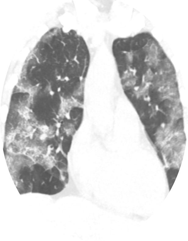 Cytokine Release Syndrome (CRS) in Severe COVID-19 Patients: Two Controversial and Interesting Case Reports and Literature Review.