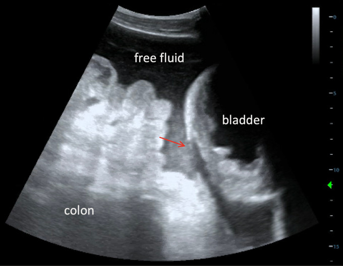 Delayed Iatrogenic Bladder Rupture Diagnosed by POCUS in the Emergency Department.