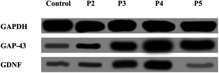 Evaluation of the concentration of growth associated protein-43 and glial cell-derived neurotrophic factor in degenerated intervertebral discs of the lumbosacral region of the spine.