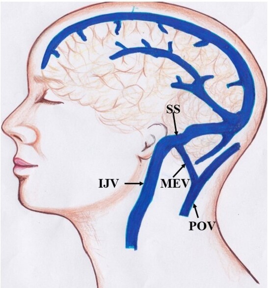 Prevalence, morphology, morphometry and associated clinical implications of mastoid emissary veins: narrative review.