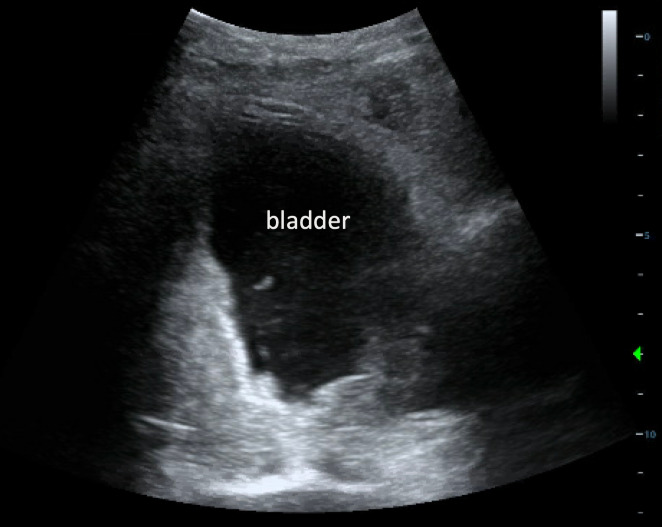 Delayed Iatrogenic Bladder Rupture Diagnosed by POCUS in the Emergency Department.