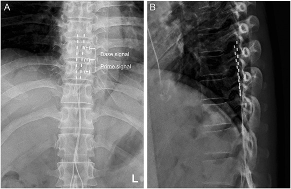 Successful use of differential target multiplexed spinal cord stimulation for chronic postsurgical abdominal pain.