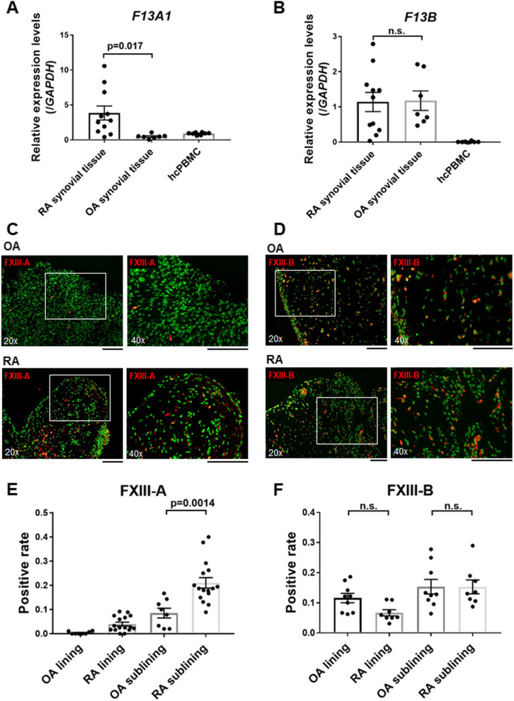 Expression of factor XIII originating from synovial fibroblasts and macrophages induced by interleukin-6 signaling.