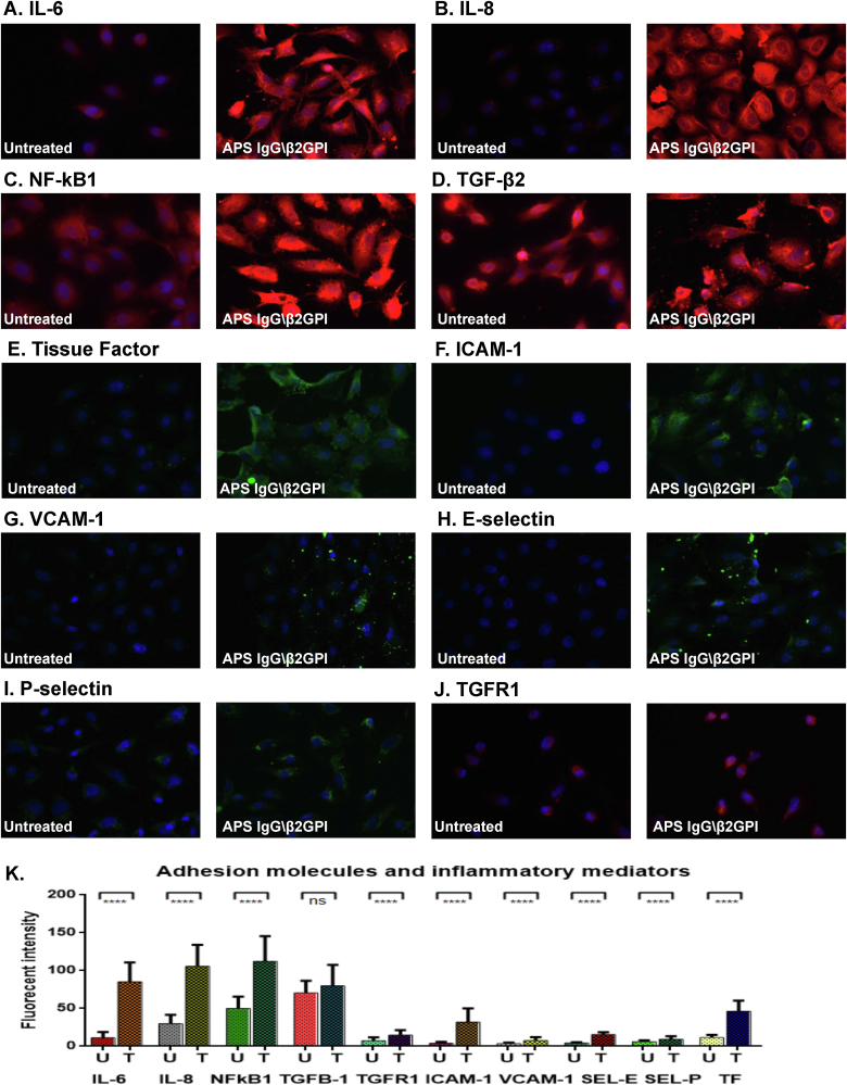 Antiphospholipid antibodies induce proinflammatory and procoagulant pathways in endothelial cells