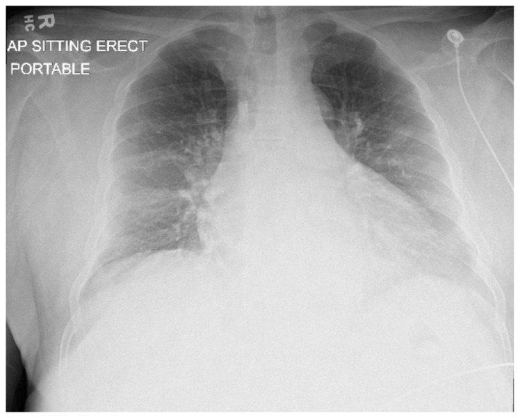 COVID-19 Viral Infection Presenting With Diabetic Ketoacidosis, Hyperosmolar Hyperglycemic Syndrome, or Mixed Hyperglycemic Crisis: A Case Series.