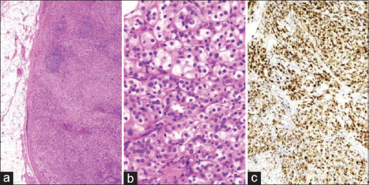 Cutaneous metastasis of castration-resistant prostate cancer: A rare case report and review of literature.