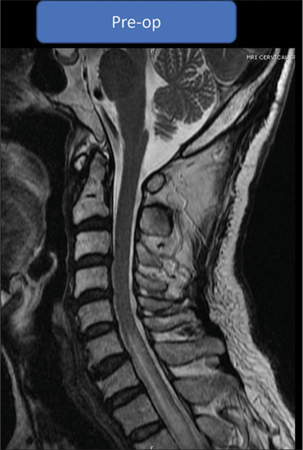 Illustrative resection of mixed intra- and extramedullary thoracic spinal cord capillary hemangioma.