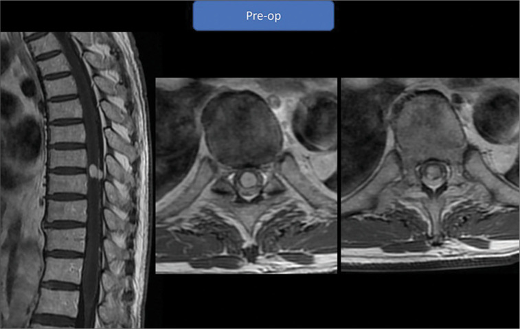 Illustrative resection of mixed intra- and extramedullary thoracic spinal cord capillary hemangioma.