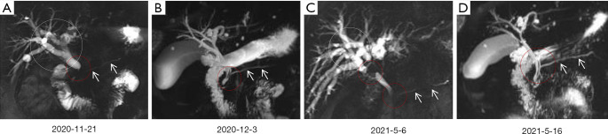 Relapsing immunoglobulin G4-related sclerosing cholangitis during maintenance treatment with low-dose steroids: a case report.