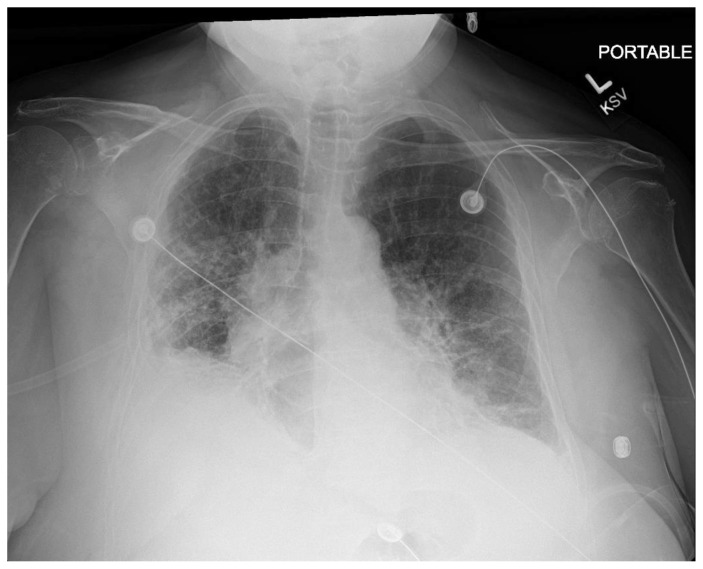 COVID-19 Viral Infection Presenting With Diabetic Ketoacidosis, Hyperosmolar Hyperglycemic Syndrome, or Mixed Hyperglycemic Crisis: A Case Series.