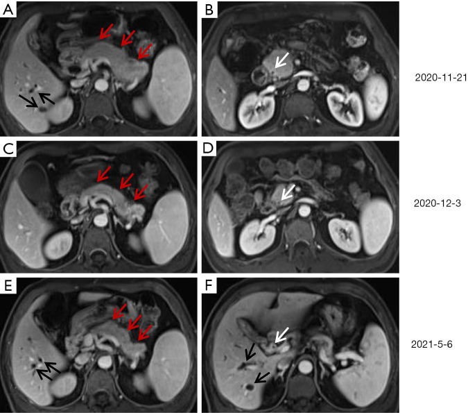 Relapsing immunoglobulin G4-related sclerosing cholangitis during maintenance treatment with low-dose steroids: a case report.