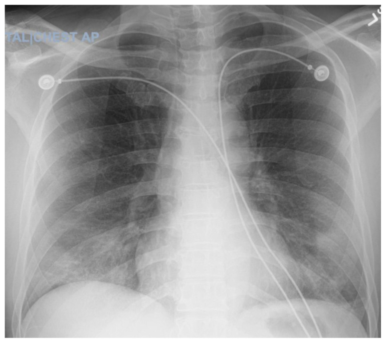 COVID-19 Viral Infection Presenting With Diabetic Ketoacidosis, Hyperosmolar Hyperglycemic Syndrome, or Mixed Hyperglycemic Crisis: A Case Series.