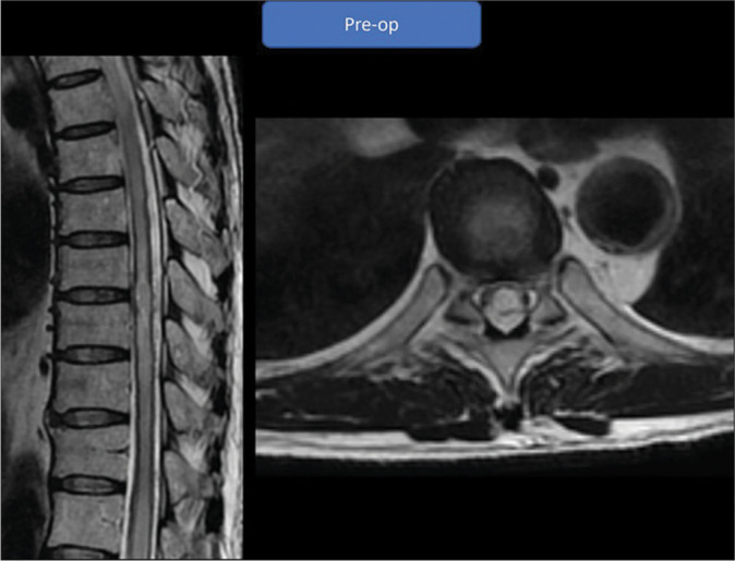 Illustrative resection of mixed intra- and extramedullary thoracic spinal cord capillary hemangioma.