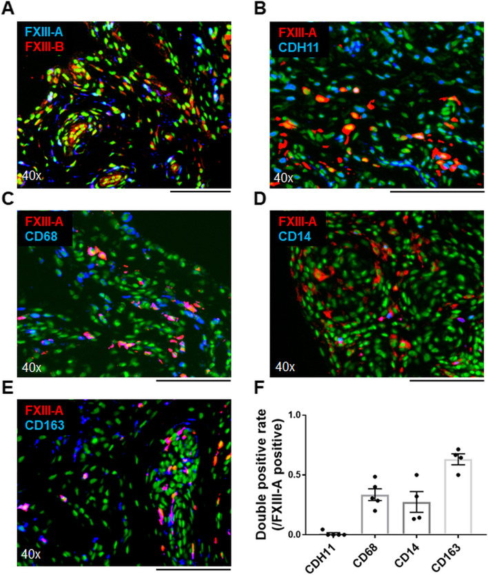 Expression of factor XIII originating from synovial fibroblasts and macrophages induced by interleukin-6 signaling.