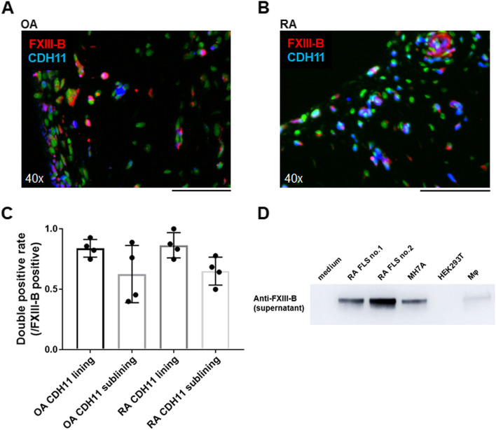 Expression of factor XIII originating from synovial fibroblasts and macrophages induced by interleukin-6 signaling.