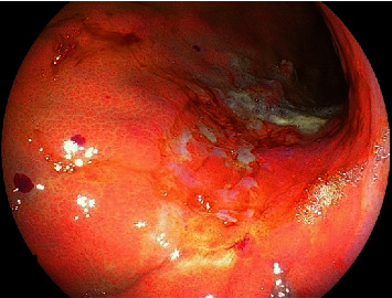 Endoscopic Image 2 Hours after PuraStat® Application: A Case of Achieving Hemostasis Using PuraStat® for Postgastric Lesion Biopsy Bleeding after Hemostatic Clips Failed.