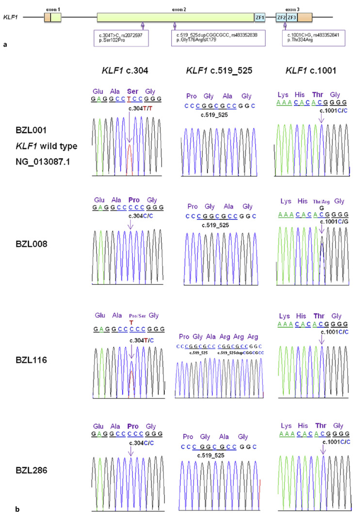 Identification of Lutheran Blood Groups and Genetic Variants within <i>KLF1</i> among Thai Blood Donors.