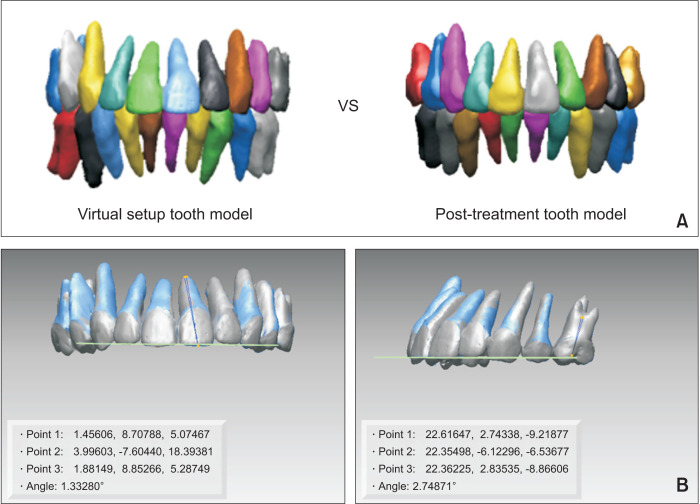 Consideration of root position in virtual tooth setup for extraction treatment: A comparative study of simulated and actual treatment results.