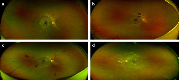 Determinants for Anemic Retinopathy.