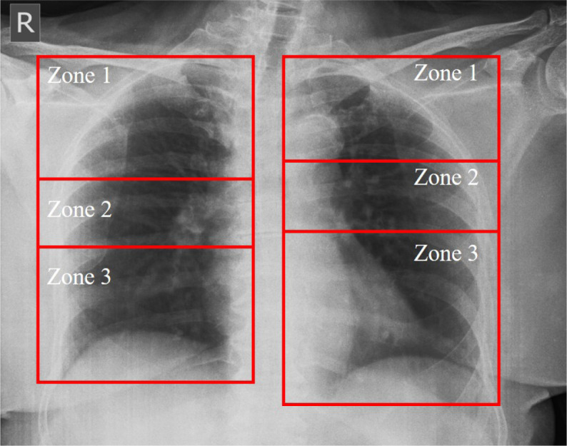 "Keep it simple - a lesson from COVID-19": highlighting the utility of chest X-rays in ARDS-associated illnesses through the Zonal Scoring System.