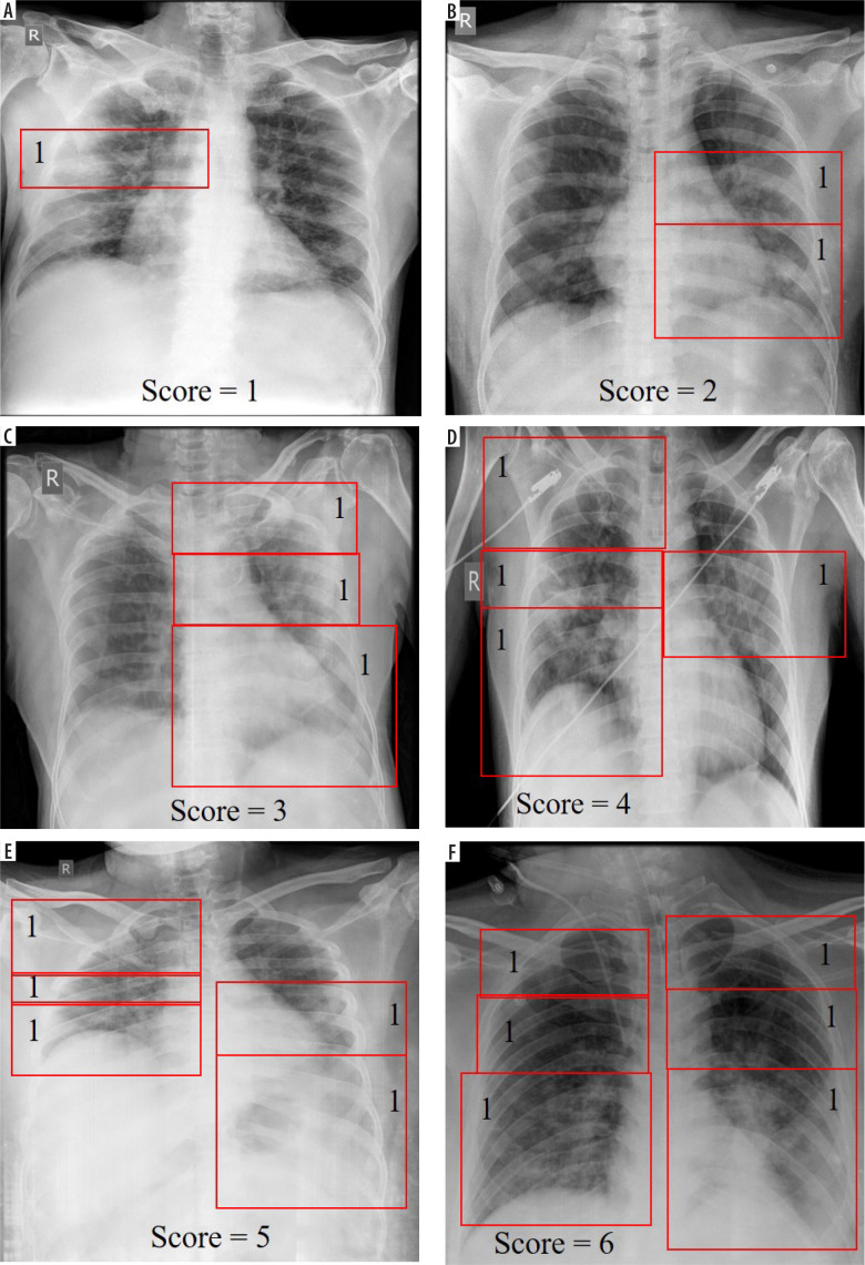 "Keep it simple - a lesson from COVID-19": highlighting the utility of chest X-rays in ARDS-associated illnesses through the Zonal Scoring System.