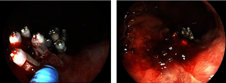 Endoscopic Image 2 Hours after PuraStat® Application: A Case of Achieving Hemostasis Using PuraStat® for Postgastric Lesion Biopsy Bleeding after Hemostatic Clips Failed.