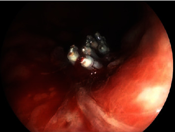 Endoscopic Image 2 Hours after PuraStat® Application: A Case of Achieving Hemostasis Using PuraStat® for Postgastric Lesion Biopsy Bleeding after Hemostatic Clips Failed.