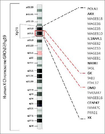 Xp21 contiguous gene deletion syndrome presenting as Duchenne muscular dystrophy and glycerol kinase deficiency associated with intellectual disability: case report and review literature.