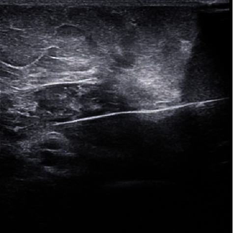 Peripheral Nerve Stimulation for the Treatment of Phantom Limb Pain: A Case Series.