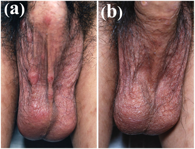 Recalcitrant nodular scabies showing excellent response to tofacitinib: five case reports.