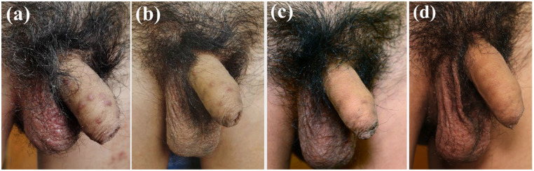 Recalcitrant nodular scabies showing excellent response to tofacitinib: five case reports.